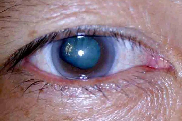 其中,原发性青光眼又分为开角型青光眼和闭角型青光眼.