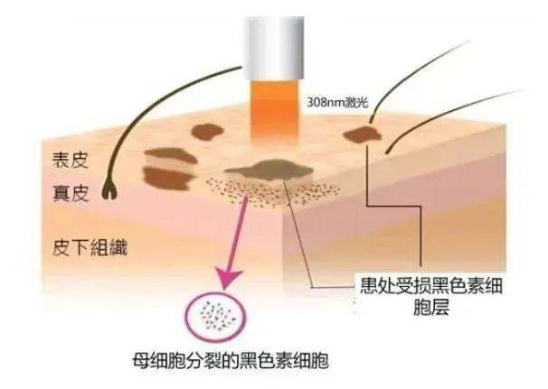 原理308nm 准分子激光治疗仪是一种利用特定波长的激光照射皮肤的医疗