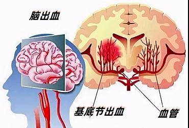 小便失禁等症状,曾在当地医院行颅脑ct检查,考虑右侧基底节区出血