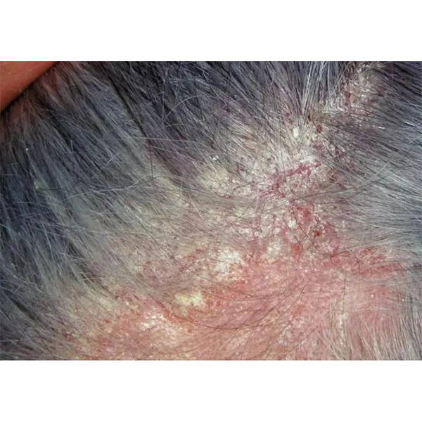 头发_去屑_头皮屑