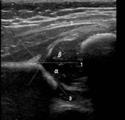耻骨联合分离超声图片图片