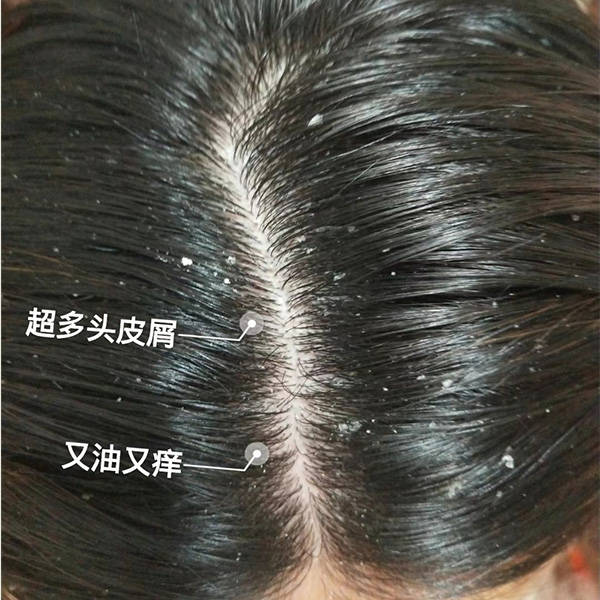 头皮屑是指头皮表面出现的脱落的小片皮肤碎屑.