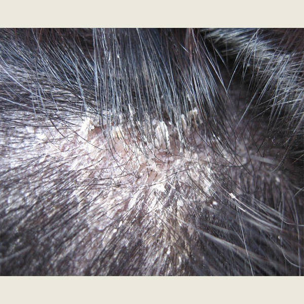 什么洗发水好用又能去屑