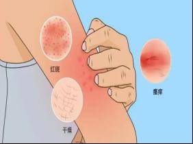 【科普】湿疹"特效药"——度普利尤单抗(达必妥)_治疗_患者_临床