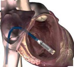 完成首例无导线起搏器植入手术,七旬老人重焕心生