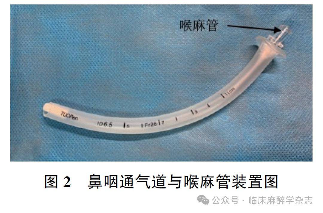 病例报道寰枢椎骨折halo支架植入患者清醒气管插管气道局部麻醉一例