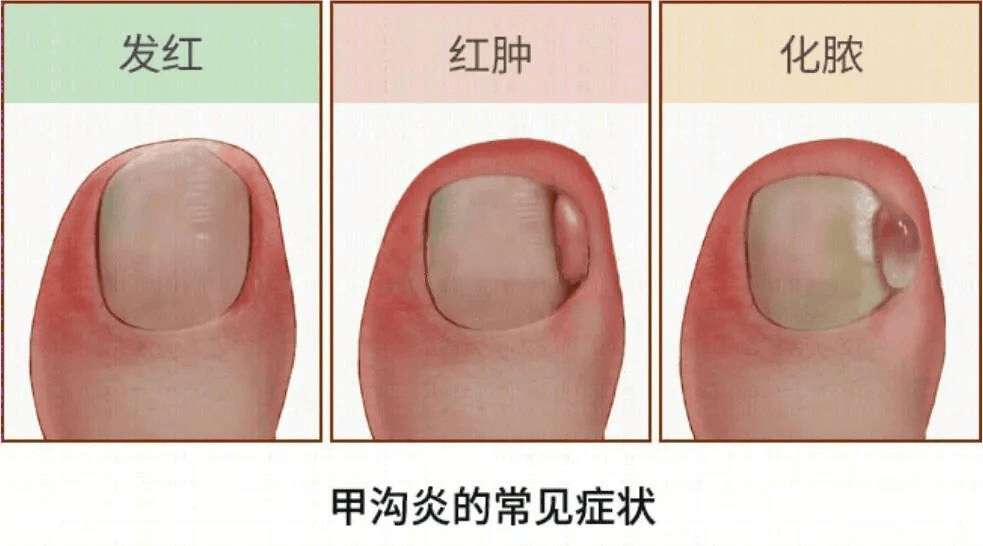 痛到灵魂出窍的甲沟炎拖着不管,等待你的可能是拔甲