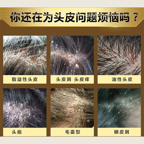 用什么洗发水能去头皮痒止痒去屑的洗发膏推荐