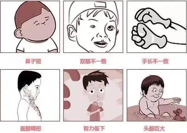 三,临床表现现代医学证实,唐氏综合征发生率与母亲怀孕年龄有关,系21