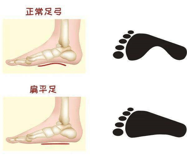 并因足底的血管神经受到挤压而致足部肿胀,疼痛甚至小腿肌肉发生痉挛