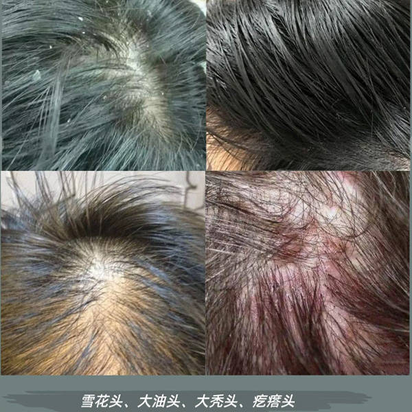 什么吕洗发水去屑止痒_头皮屑_问题_因素