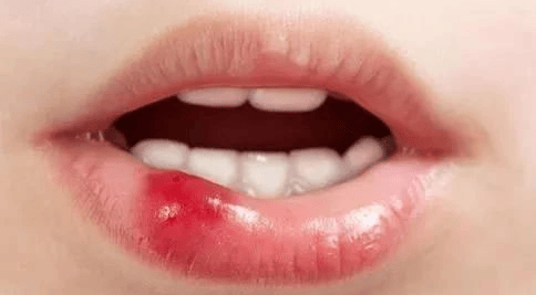 脾胃受伤嘴先知嘴巴出现这6种迹象一定要重视