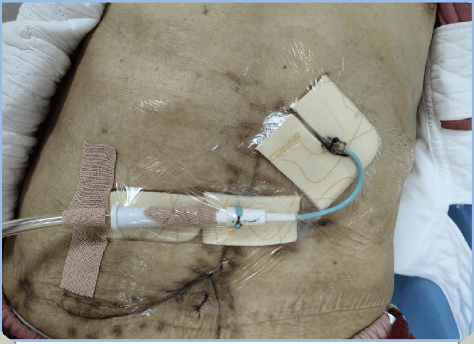 "管"注细节,手"护"有道——科室ptcd管道规范化管理经验分享