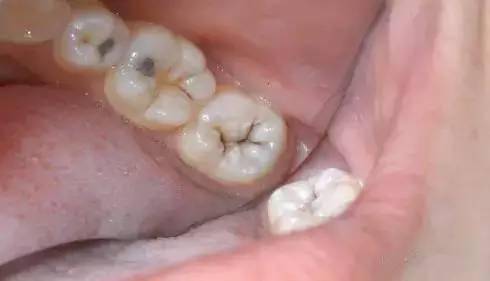 零食,打扰我们美好的生活(牙医称"窝沟封闭")主人请一定给我们穿上