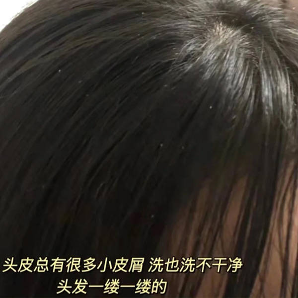 青少年男去屑洗发水推荐_问题_头发_黛熙
