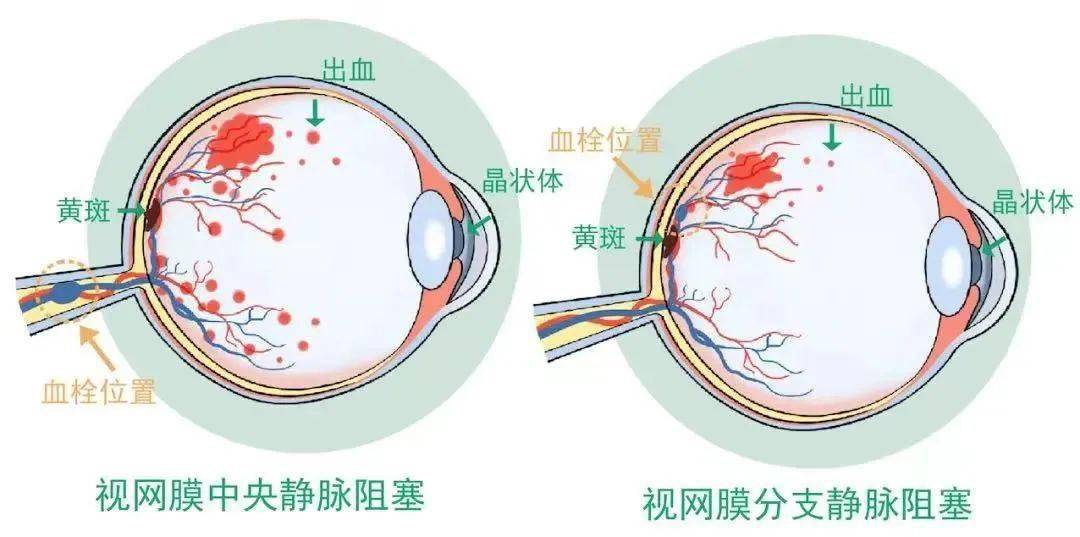 视网膜血管分布图图片