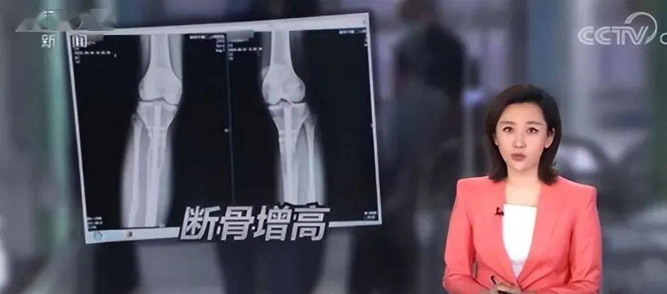 20岁北京男孩李亚诺花16万断骨增高72厘米后来怎样了