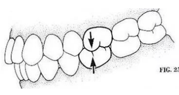 吃饭老咬到腮帮子咋回事
