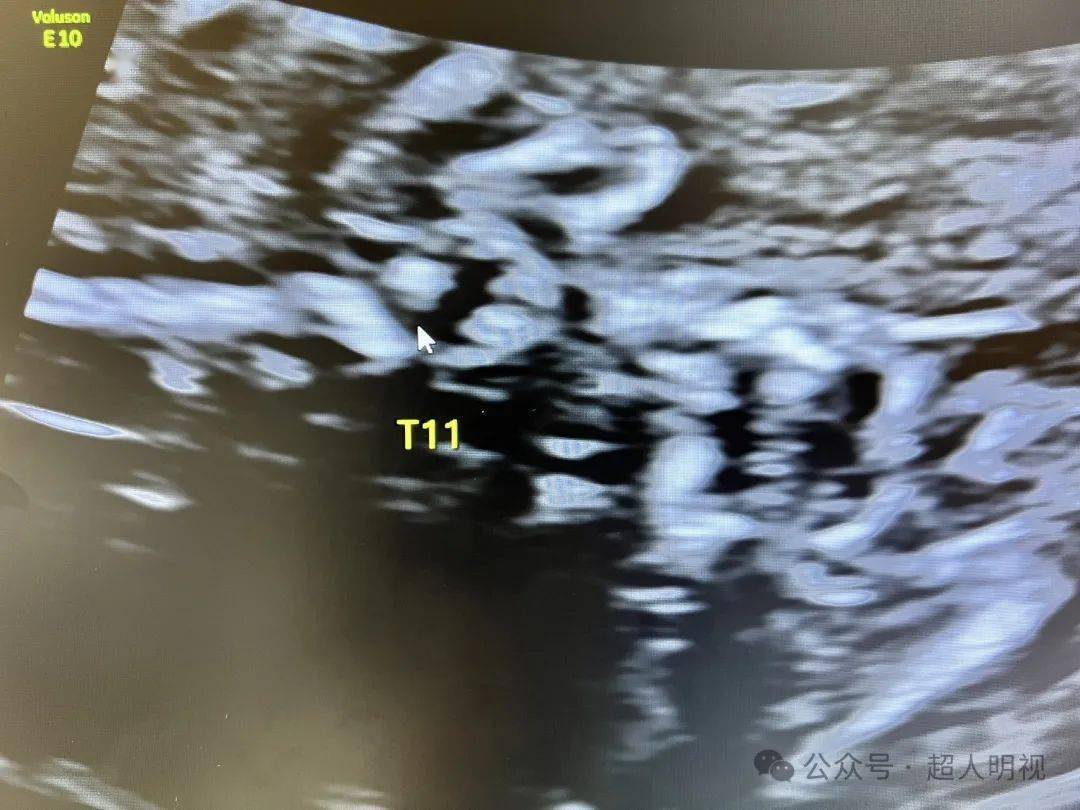 胎儿半椎体(hemivertebra)