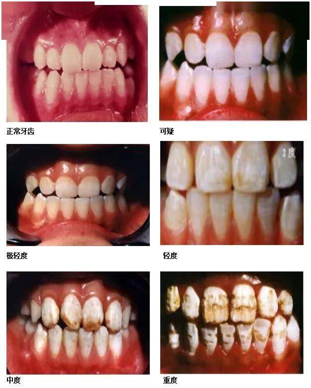 牙齿美白色阶程度图图片