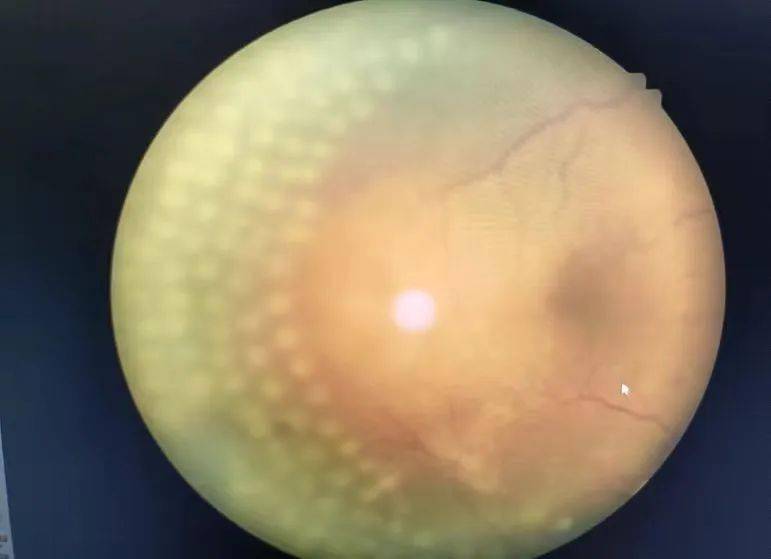 迎难而上吓人得了糖尿病会摘除眼球