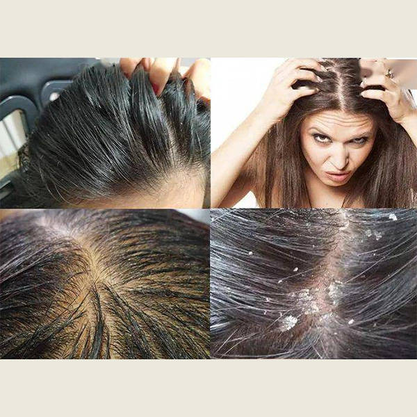 二硫化硒洗发水真的有用吗去屑效果很好的洗发水排行榜