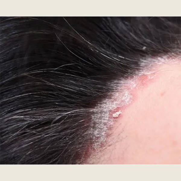 头皮痒用什么洗发水好一点??好用的去屑洗发水推荐_头发_问题_成分