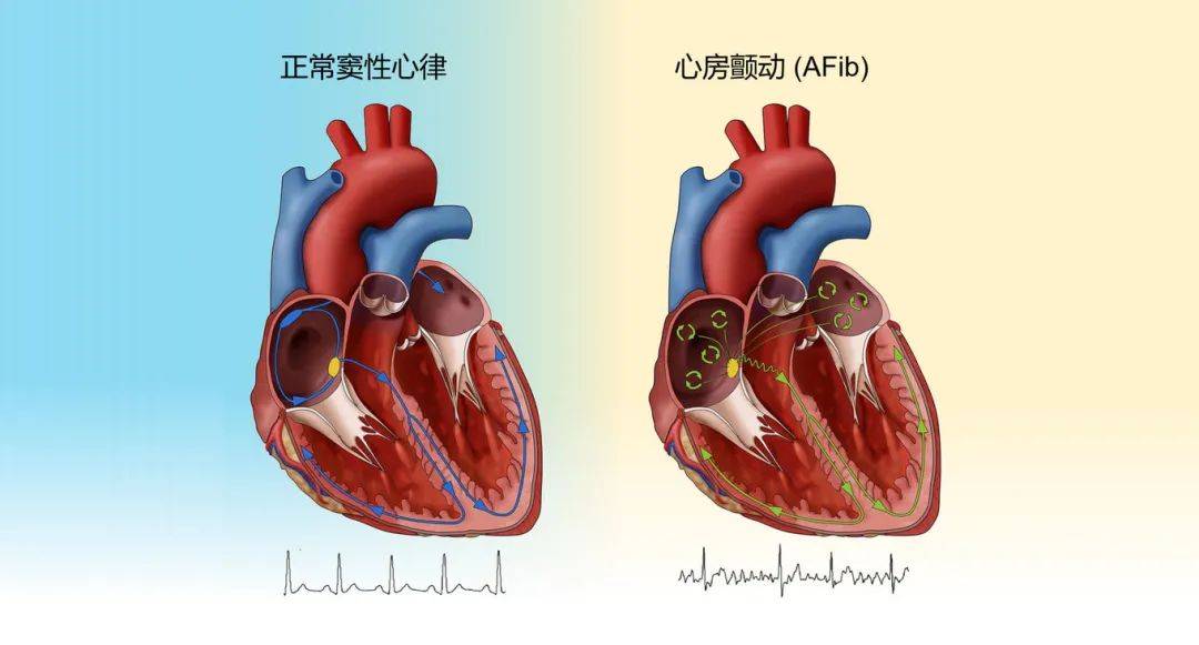 健康课堂房颤是什么你不知道的心脏秘密