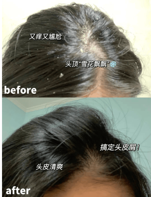 止痒去屑控油洗发水排行榜_头皮屑_问题_头发