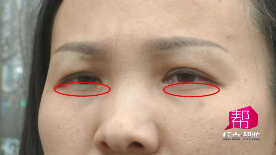 女子切除眼袋后留下明显疤痕 星海荟医疗美容院:与体质有关(图2)