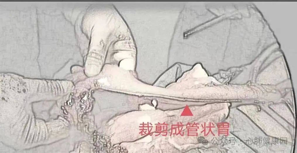 又开展了第二例免开胸单孔充气纵隔镜联合单孔腹腔镜食管切除重建手术