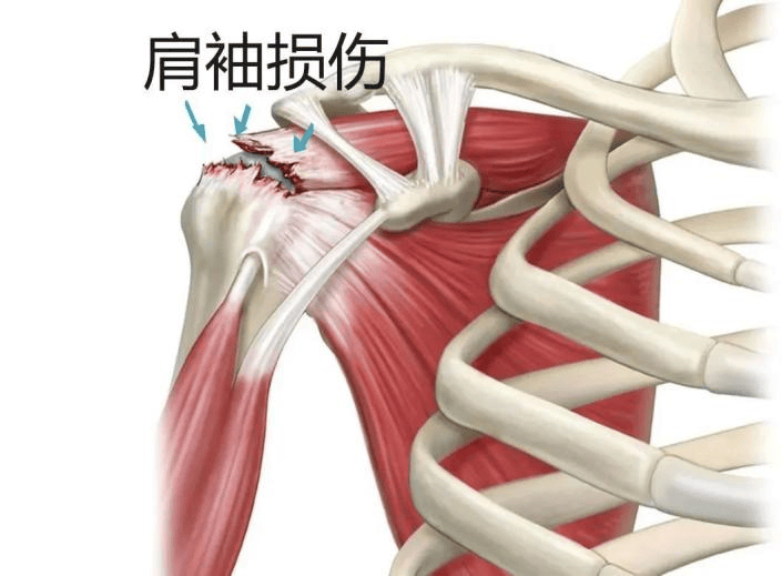 肩袖损伤位置图片图片