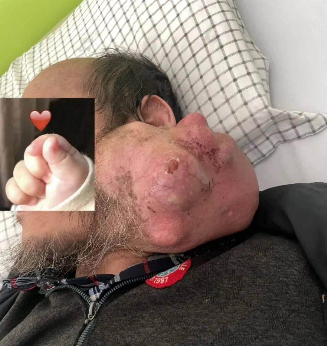 what?脖子上长出头大的瘤子!医生:从医30年头次见