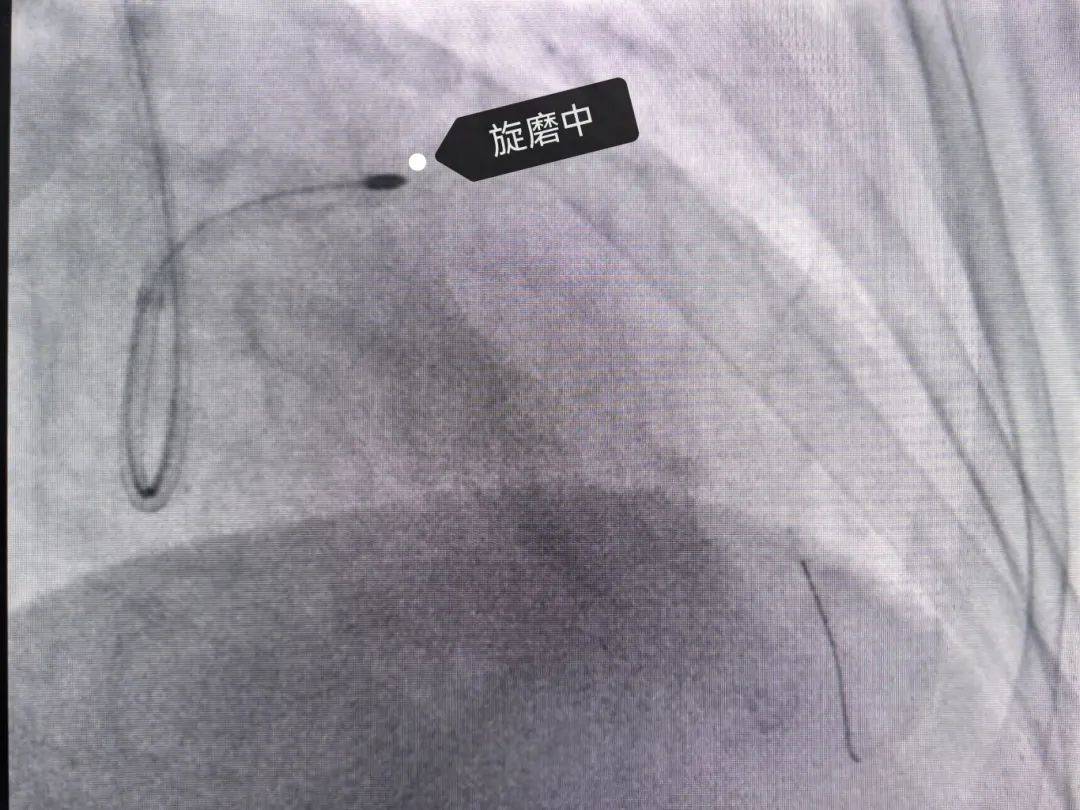发展丨重庆医科大学附属南川医院成功开展南川区首例冠状动脉旋磨术
