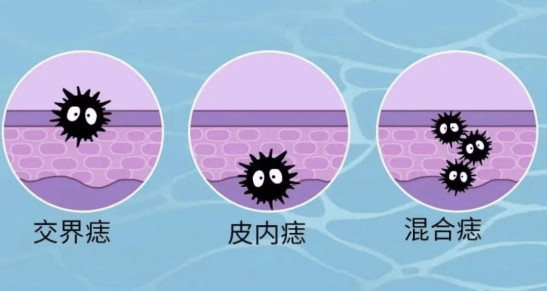 金小鸥讲健康色素痣是怎么回事都需要点了吗听皮肤科专家怎么说