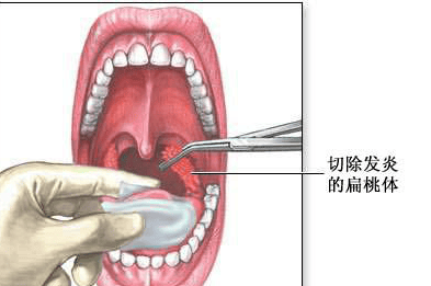 扁桃体肥大怎么治图片图片