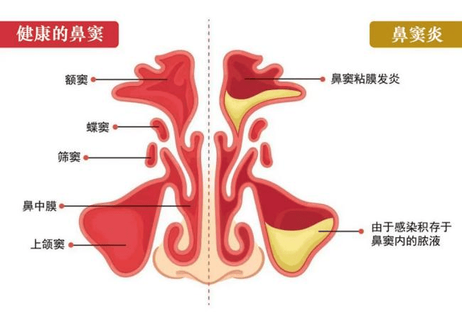 金小鸥讲健康全国爱鼻日鼻腔疾病预防重在日常护理