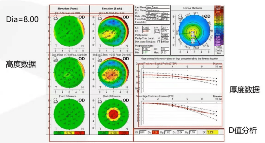 角膜地形图上看kappa角图片