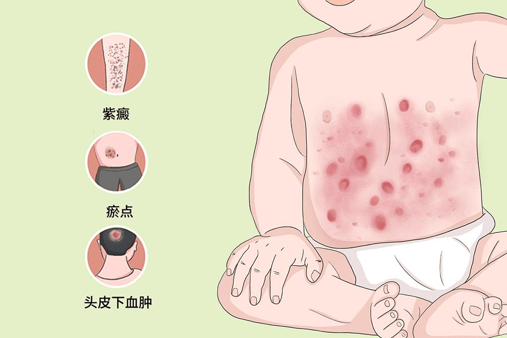 血小板紫癜怎么治疗图片