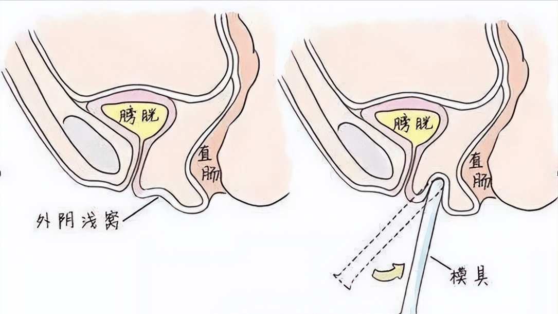 什么是石女?如图所示图片