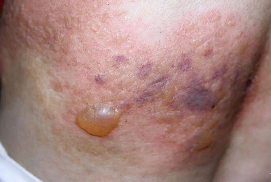 带状疱疹典型症状3.