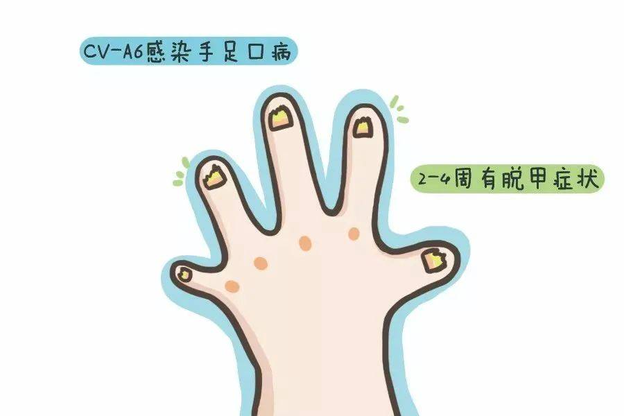 手足口病来袭,家有孩童请注意_儿童_传播