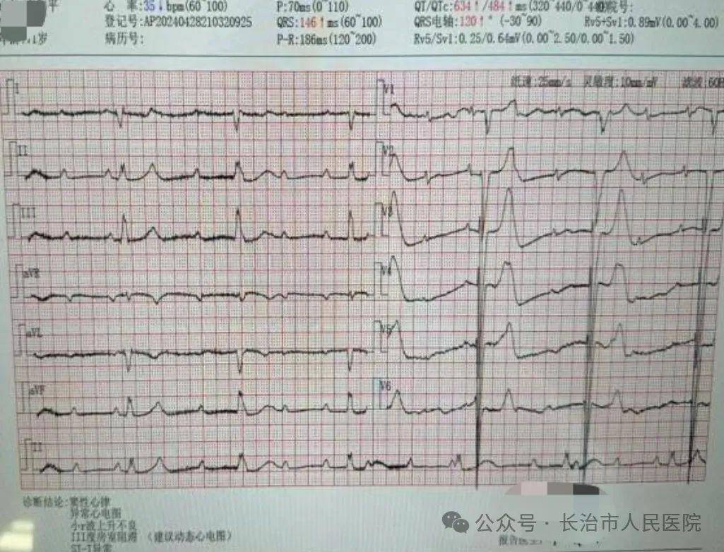 起搏器植入术前心电图起搏器植入术后心电监护随着人口老龄化,病窦