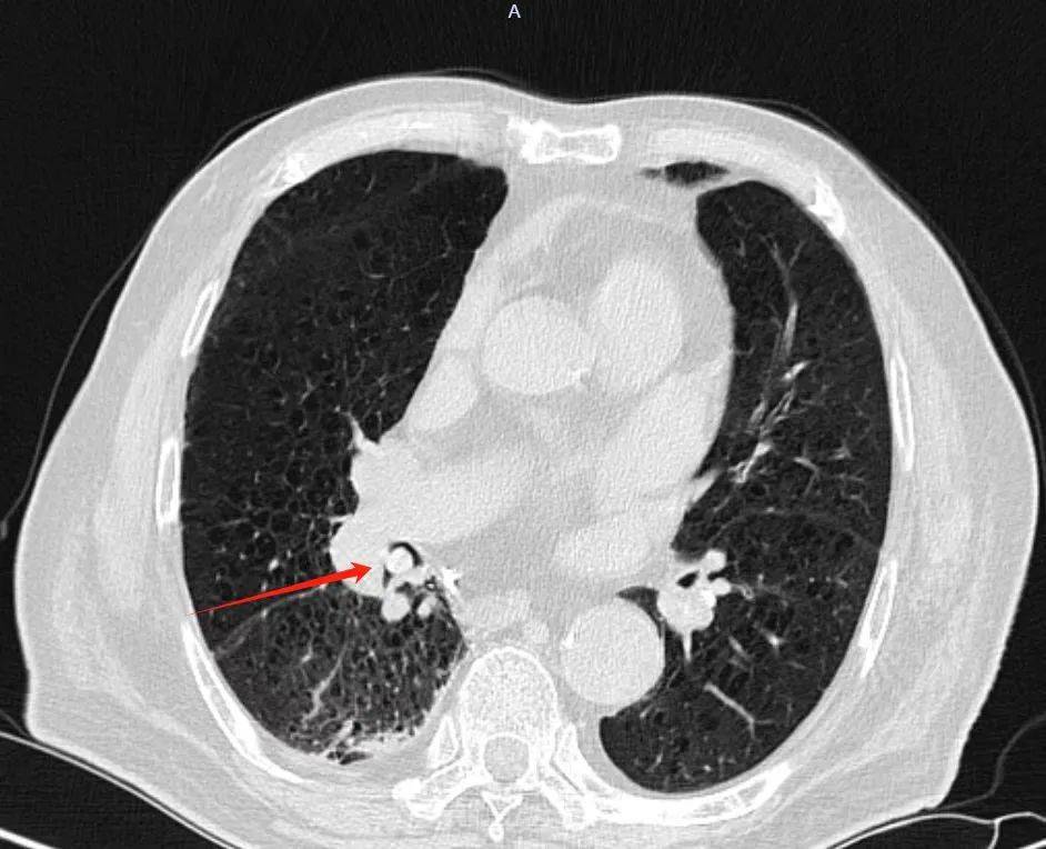 "我们根据他吃蚕豆饭的病史,判定他大概率是把豌豆误吸进了肺部.