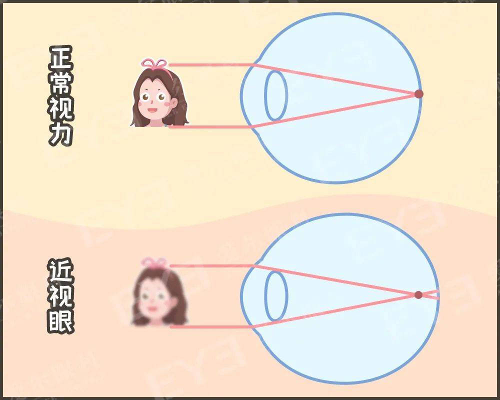 近视眼球对比图片