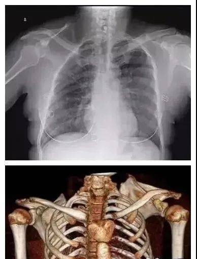 【科普】十种脊柱畸形分享