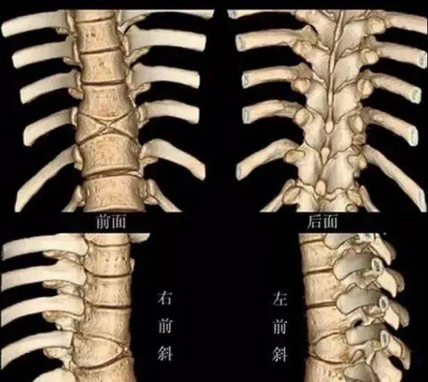 脊柱裂正位脊柱隐裂双侧椎板不连,相应水平棘突发育小或缺如