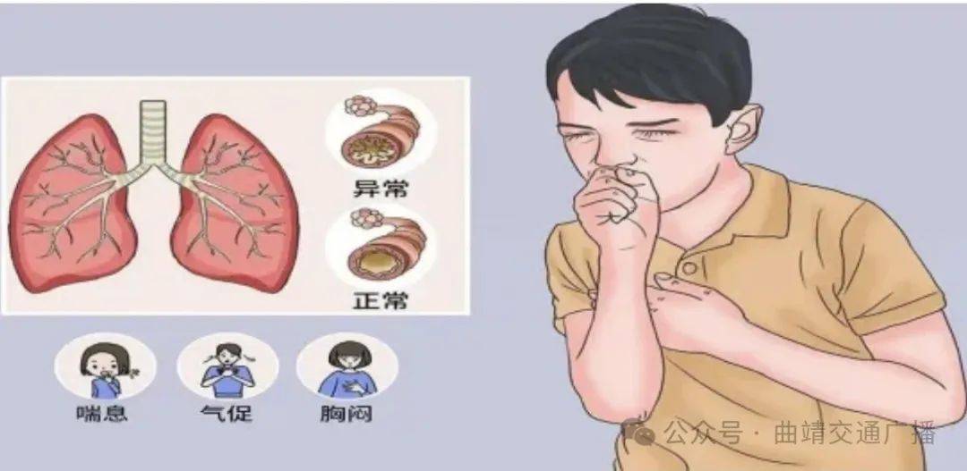 一,什么是支气管哮喘?