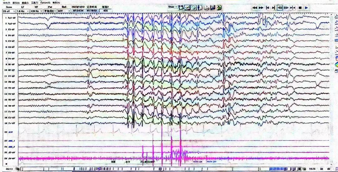 中度异常脑电图要紧不图片