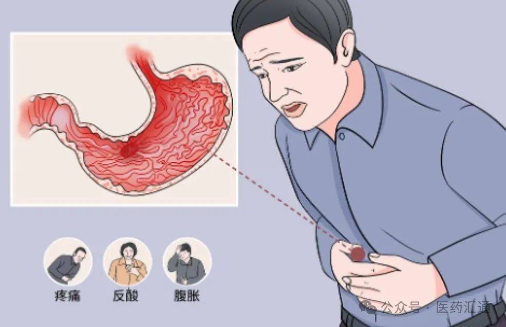 "胃萎缩"不能放任不管